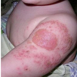 Прививки - прививка БЦЖ.jpg