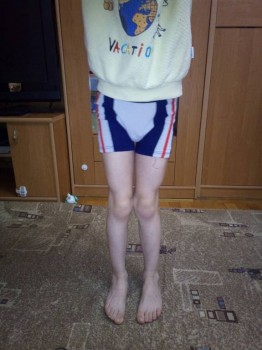 Операция ребенку на плоско вальгус стопы - 0636c8fb-e4df-43f4-9d29-355c150d7a87.jpg