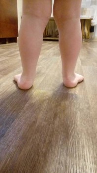 Операция ребенку на плоско вальгус стопы - 20180318_195536.jpg