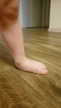 Операция ребенку на плоско вальгус стопы - 20180318_195617.jpg