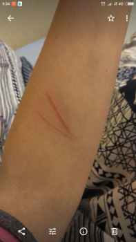 Для сравнения-моя рука 15 мин спустя. Реакция нулевая.