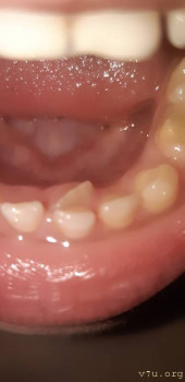 За молочным зубом растет постоянный но криво. - 20211115_064110.jpg