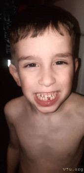 За молочным зубом растет постоянный но криво. - 20211115_190810.jpg