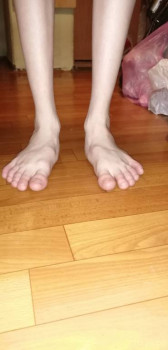 Операция ребенку на плоско вальгус стопы - IMG_20220312_202739.jpg