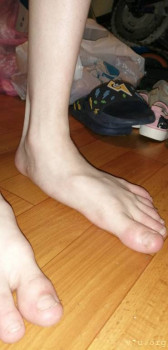 Операция ребенку на плоско вальгус стопы - IMG_20220312_202729.jpg