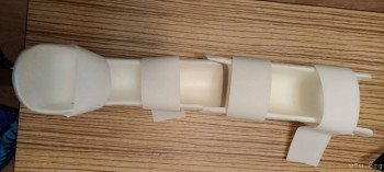 Эквинус- предстоит операция. Чего ожидать? - WhatsApp Image 2024-02-04 at 20.05.31 (2).jpeg