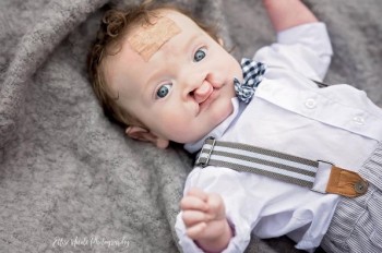 Расщелина губы фото малыша до и после операции  - Screenshot_7.jpg