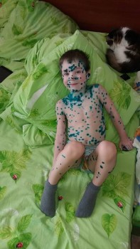 П5рвая улыбка... до этого 4 дня в лежку... некоторые прищики прямо как язвы